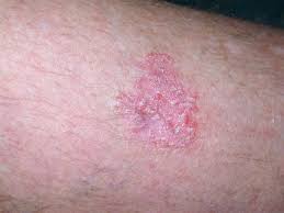Skin cancer is the most common type of cancer in the united states by a pretty large margin, and it does not discriminate. Skin Cancer Pictures Most Common Skin Cancer Types With Images