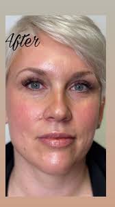 ✨ After a year of convincing, our incredible OG client finally took the  plunge with Revanesse lip fillers, and the results are stunning! , 💋 Her  beautifully plump lips are a perfect enhancement that ...