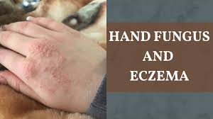 Image result for Hand Infection