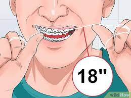 How to brush your teeth with braces wikihow. How To Clean Teeth With Braces 12 Steps With Pictures Wikihow