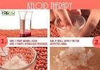 Pimple Turned Into Keloid