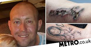 People left with blisters and burns after laser tattoo removals go wrong