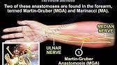 Anastomosis is most commonly used to secure upper and lower sections of the large intestine together after a middle. Martin Gruber Anastomosis Everything You Need To Know Dr Nabil Ebraheim Youtube