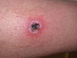 Any other cold liquid that does not. Cryotherapy Dermnet Nz