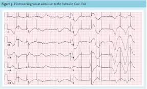Image result for Flecainide Overdose