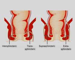 Fistulas can form between various parts of the body, including between the uterus and the peritoneal cavity (metroperitoneal, or uteroperitoneal. Anal Fistula Surgery In Dubai Dr Antonio Privitera