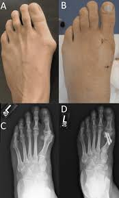 Image result for Hallux Varus