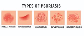 Maybe you would like to learn more about one of these? Types Of Psoriasis People Tree Hospitals