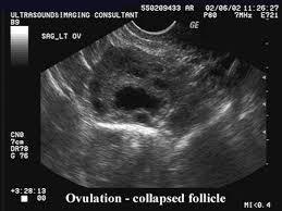 Image result for corpus luteum sonography)