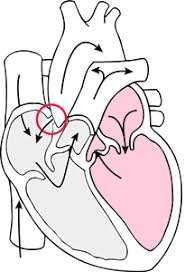 Atrial Septal Defect Atrial Septal Defect Medical Dictionary Medical Terms