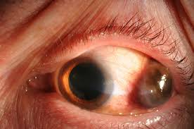 Image result for lesion sclera
