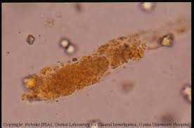 Image result for Urinary Cast