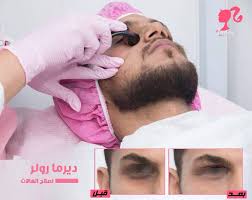 الديرمارولر Derma Roller لعلاج الهالات مركز باربي الطبي للتجميل والليزر Facebook