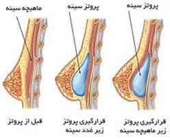 Image result for â«Ø¢ÛØ§ Ù¾Ø±ÙØªØ² Ø¨Ø§Ø¹Ø« Ø³Ø±Ø·Ø§Ù Ø³ÛÙÙ ÙÛØ´ÙØ¯â¬â