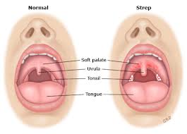 Image result for Strep throat infection roof of mouth