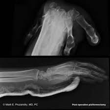 Image result for Pisiform Bone
