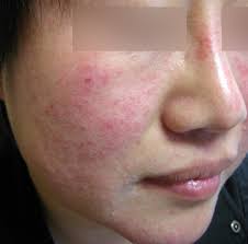 Von acne fulminans spricht man, wenn eine acne conglobata von knochenschmerzen und einer systemischen vaskulitis begleitet ist. What Are The Causes Of Rosacea Acne And Rosacea Society Of Canada