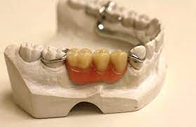 Perawatan behel gigi tambal gigi gigi palsu scaling. Babeh Dental Harga Pasang Gigi Palsu Paling Murah Di Bandar Lampung Tanjung Karang Natar Bandara Raden Intan