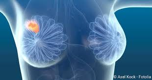 Alle brustwarzen haben ihre individuelle farbe. Brustkrebs Risikofaktoren Behandlung Vorbeugung Netdoktor