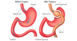 Mini gastric bypass surgery has had a long road to acceptance primarily because it has had to contend with the already established and popular information is coming out that many people with the sleeve develop terrible heartburn and they have to have the rny gastric bypass to stop the heartburn! What Is The Mini Gastric Bypass Winnett Specialist Group