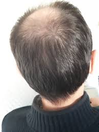 Hlc Estetik 3000 Greft Ekim