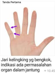 Kelingking adalah jari terkecil di kaki dan posisinya yang berada di sisi luar membuatnya rentan terhadap cedera akibat jatuh, tersandung pada sesuatu, atau terjatuh benda. Pijat Fisiodiagnosis Melihat Permasalahan Penyakit Facebook