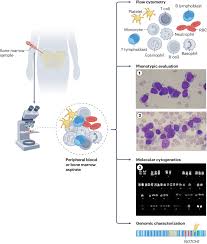 Image result for Acute Leukemia