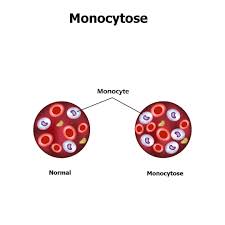 Quelques repères pour le bon déroulement de votre prise de sang, et pour mieux comprendre les résultats. Monocytes Hauts Bas Normes Role Interpretation Du Taux