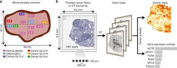 Treatment for bladder cancer depends on your overall health, progression of the c. Spatial Maps Of Prostate Cancer Transcriptomes Reveal An Unexplored Landscape Of Heterogeneity Nature Communications