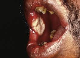 Image result for Aphthasol