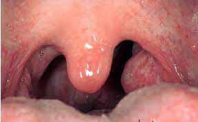 I can't see any tonsil stones persistently, however, i have gotten a few out from my mouth in the past (and td;lr tonsils smell bad, but i can't see any tonsil stones. Healthy Tonsils Figure 3 Disease Affected Tonsils Download Scientific Diagram