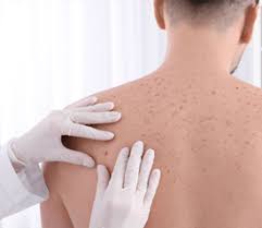 Image result for Lymphoma