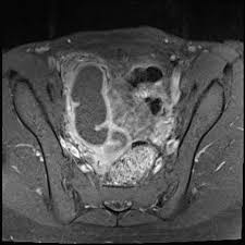 Pelvic Inflammatory Disease Radiology Reference Article Radiopaedia Org