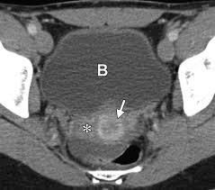 Learn about endometriosis, including possible treatments for this condition that causes pain and sometimes infertility. Normal Or Abnormal Demystifying Uterine And Cervical Contrast Enhancement At Multidetector Ct Radiographics