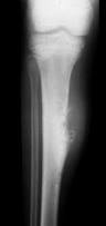 Image result for Osteosarcoma