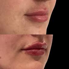 What Is Dermal Filler Migration? How Do I Avoid It? - Intrigue Clinic