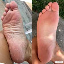 This Exfoliating Foot Peel Is The Definition Of Gross But Satisfying