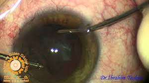 A cataract is a cloudy area in the lens of the eye that leads to a decrease in vision. Arka Polar Katarakt Posteriorkapsuloreksis Youtube