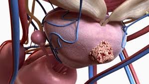 Explains prostate problems including prostatitis and benign prostatic hyperplasia. Prostatakrebs Entfernung Der Prostata Ist Ein Umstrittener Eingriff Der Spiegel