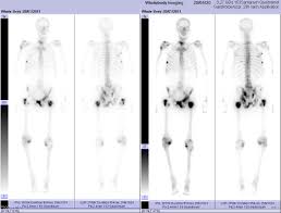 Wie läuft die untersuchung ab? Datei Verlauf Prostatakrebs 2011 01 Posttherapie Szintigramm Jpg Wikipedia