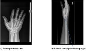 We did not find results for: Lunate Dislocation Presentation Of Two Cases Of A Rare Condition Abstract Europe Pmc