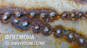 Image result for phlegmon of hand)