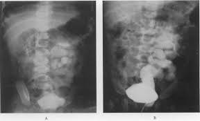 Image result for Intravenous Pyelogram