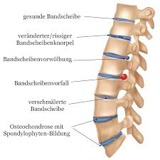 We did not find results for: Osteochondrose In Der Wirbelsaule Und Den Gelenken Liebscher Bracht