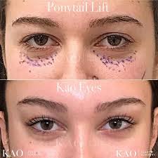 Cat Eye Surgery Pony Tail Lift Plastic Surgery Cirugia Cosmetica Blepharoplasty Eye Lift Surgery Cat Eye Makeup Eye Surgery