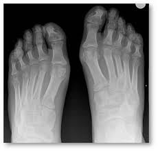 Image result for XRay Changes in Rheumatic Conditions