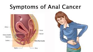 In general, the lower the number, the less the cancer has spread. 6 Symptoms That Could Indicate Anal Cancer Womenworking