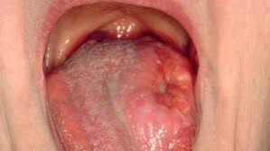 Image result for white cancer on tongue)