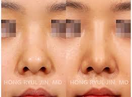 Rhinoplasty is a procedure that involves reshaping the nose. 1 Shape Of Bulbous Nose Bulbous Nose Has A Wide And Big Nasal Bridge And Tip So Bulbous Nose Rhinoplasty I Bulbous Nose Bulbous Nose Rhinoplasty Rhinoplasty