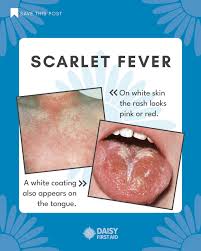 Image result for Scarlet Fever